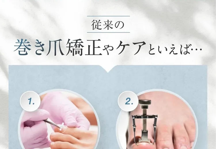 自分で巻き爪矯正・自宅でセルフケア｜痛みに配慮した矯正プレート